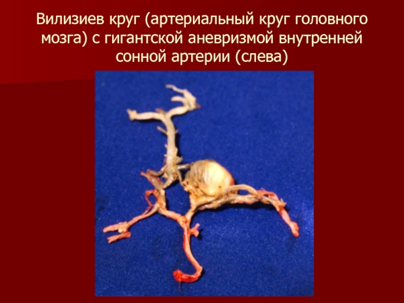 Аневризма сонной артерии симптомы