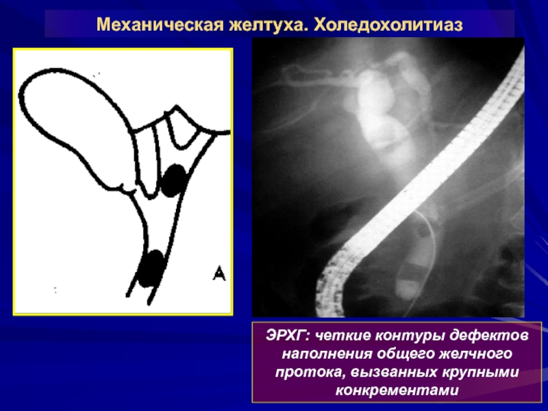 Хирургия механическая желтуха презентация