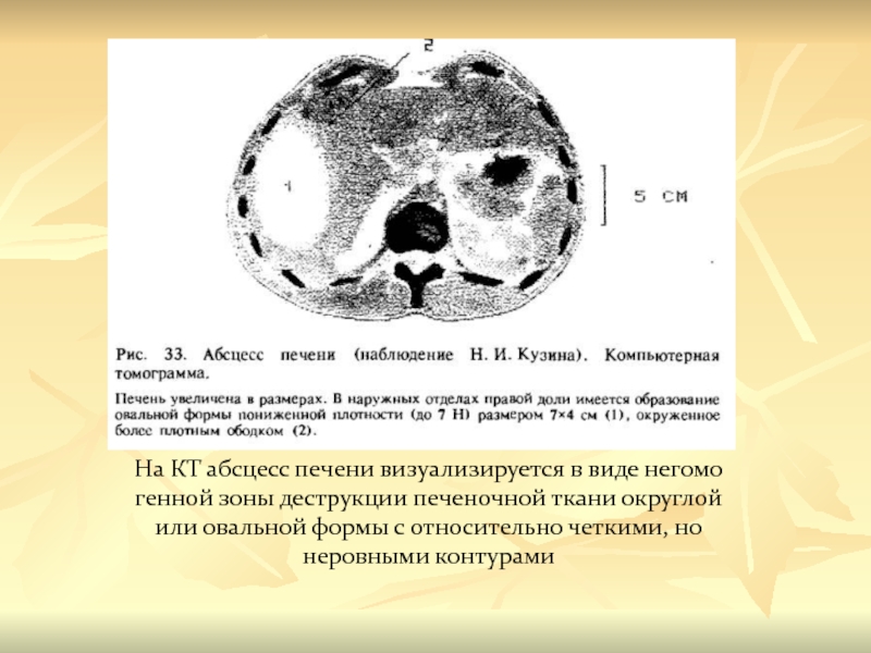 Абсцесс печени картинки