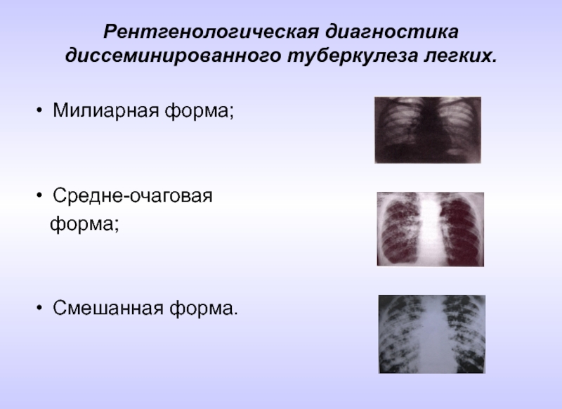 Диссеминированный туберкулез легких фазы