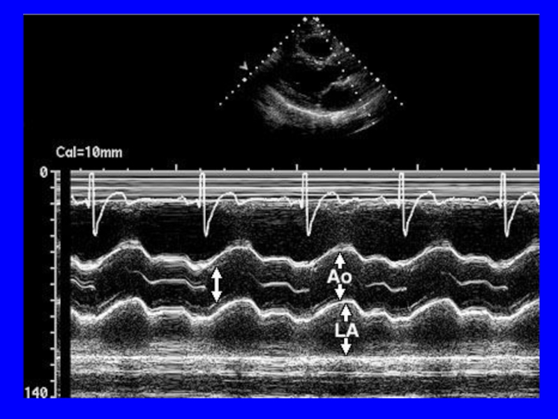 М режим. ЭХОКГ аортальный стеноз м-режим. М режим аортальный клапан. Стеноз митрального клапана ЭХОКГ М режим. Стеноз аортального клапана ЭХОКГ.