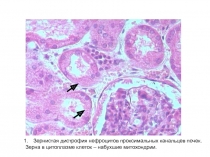 Зернистая дистрофия нефроцитов проксимальных канальцев почек.
Зерна в
