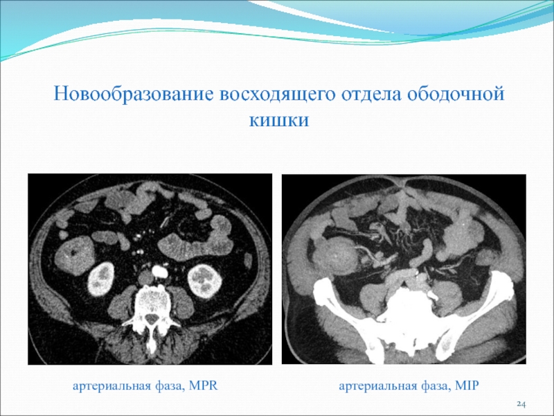 Mip изображение кт