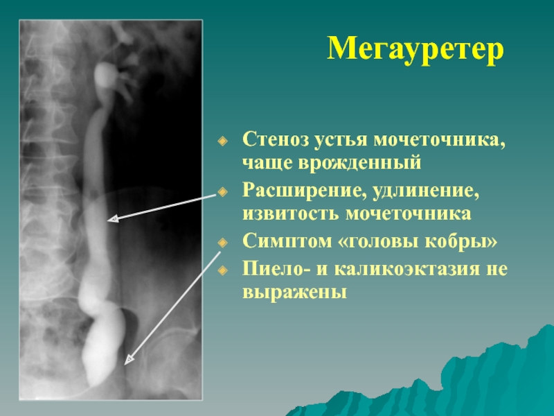 Гидронефроз презентация детская хирургия