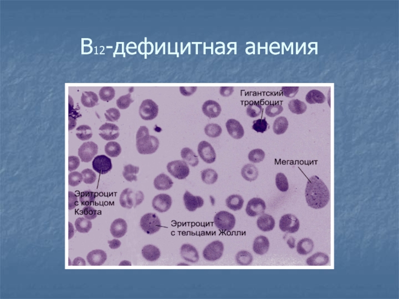 B12 анемия презентация