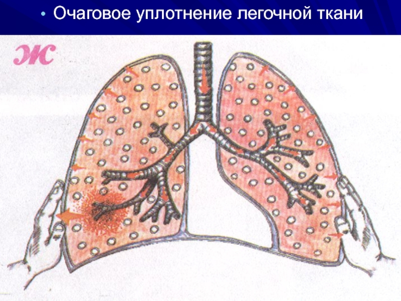 Уплотнение ткани. Уплотнение легочной ткани. Очаговре уплотнения легочной ткани. Долевое уплотнение легочной ткани. Долевое и очаговое уплотнение легочной ткани.