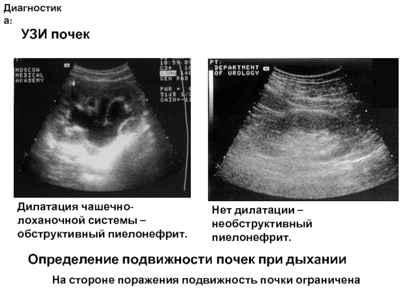 Пиелонефрит узи картина