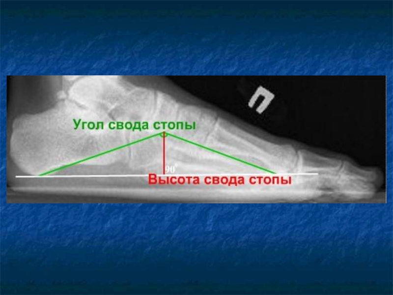 Углы стопы. Высота свода стопы. Угол свода стопы. Высота и угол свода стопы. Нормальная высота свода стопы.