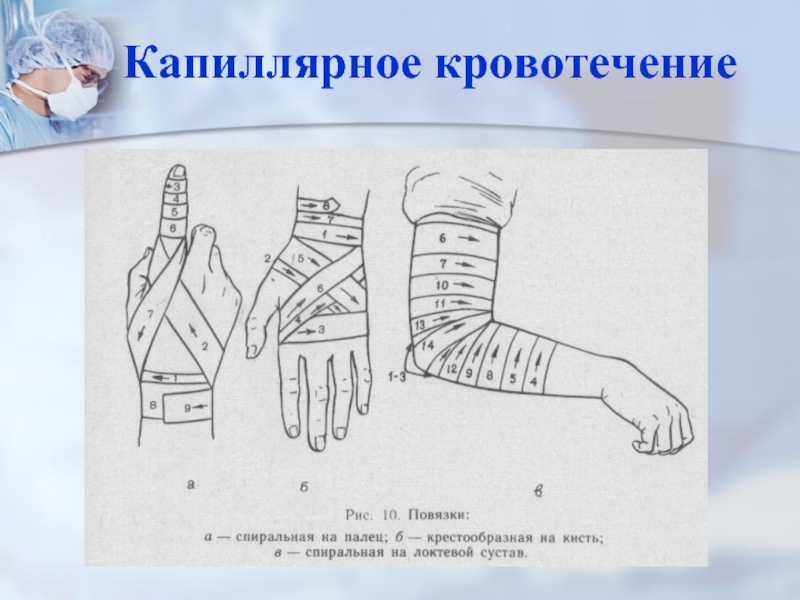 Наложение повязки при кровотечении. Повязка при капиллярном кровотечении. Наложение повязки при капиллярном кровотечении. Повязка для остановки капиллярного кровотечения. Перевязка при капиллярном кровотечении.