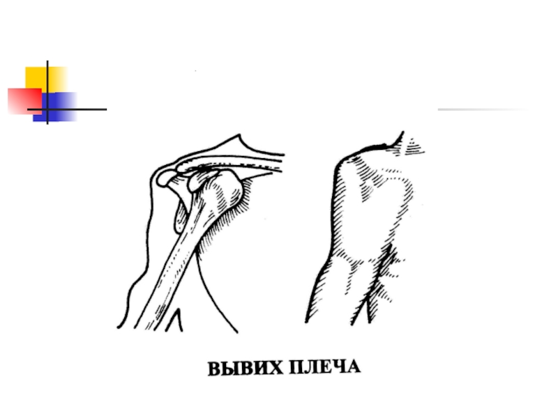 Переломы и вывихи общая хирургия презентация