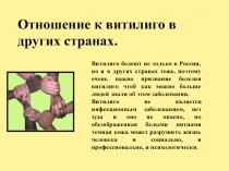 Отношение к витилиго в других странах