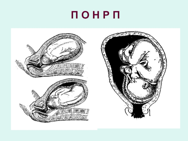 Международный день по искоренению акушерских свищей картинки