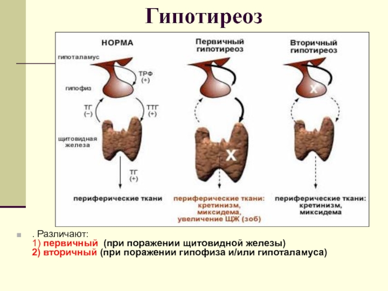 Гипотиреоз что это такое. Первичная гипофункция щитовидной железы. Третичный гипотиреоз. Гипотиреоз первичный вторичный третичный. Снижение функций щитовидной железы (гипотиреоз).