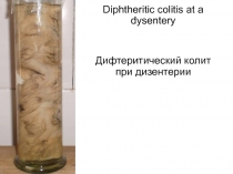 Дифтеритический колит при дизентерии 