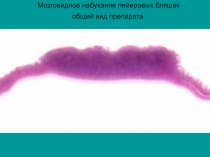 Мозговидное  набухание 