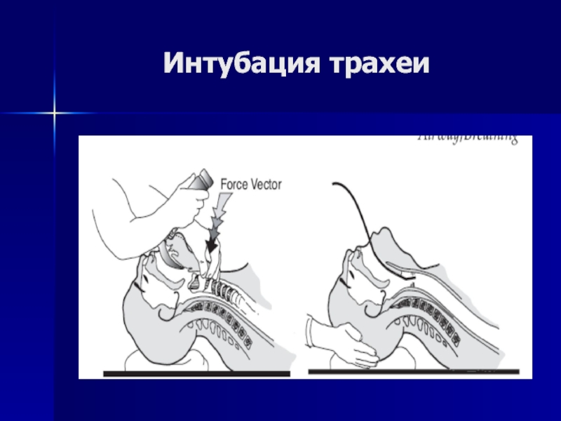 Интубация трахеи. Интубация у детей особенности. Интубация трахеи через синус угла.