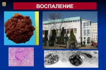 Воспаление 