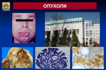 Опухоли 