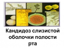 Кандидоз слизистой оболочки полости 