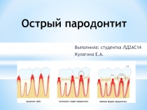 Острый пародонтит