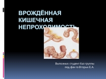 Врождённая кишечная непроходимость
