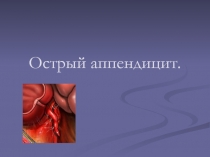 Острый аппендицит 