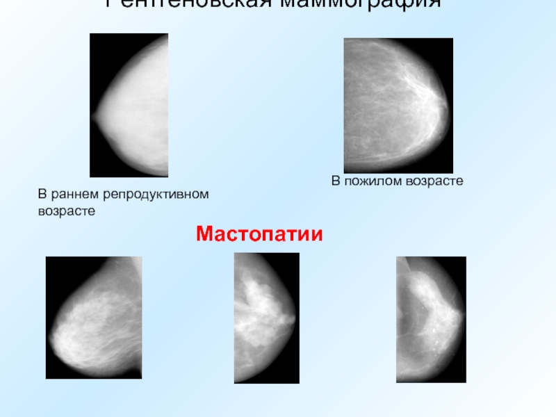 Гиперплазия молочной железы. Мастопатия на маммографии. Квадранты молочной железы на маммограмме. Рентгеновская маммография.