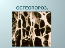 Остеопороз 