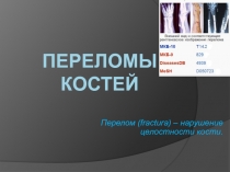 Переломы костей 