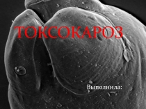 токсокароз 