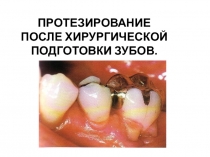 ПРОТЕЗИРОВАНИЕ ПОСЛЕ ХИРУРГИЧЕСКОЙ ПОДГОТОВКИ ЗУБОВ 