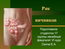 Рак яичников