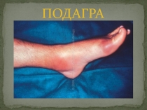 Подагра