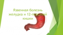 Язвенная болезнь желудка и 12-перстной кишки