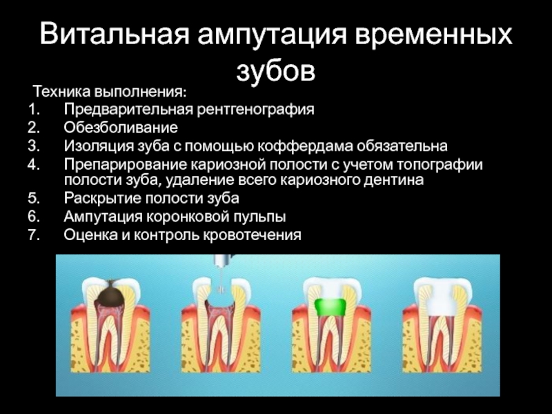 Витальная ампутация пульпы. Витальная экстирпация временных зубов. Витальная ампутация временных зубов. Метод витального окрашивания зубов.