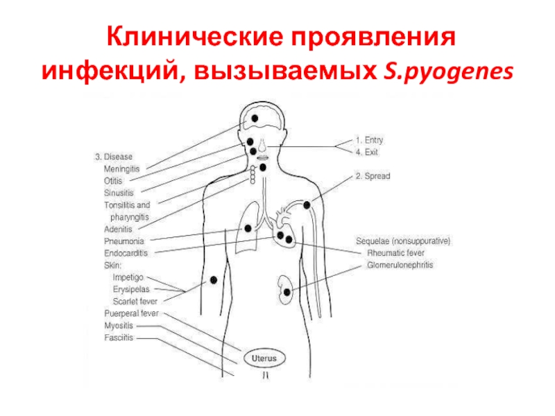Раневые инфекции Клинические проявления инфекций, вызываемых S.pyogenes Клинические проявления инфекций, вызываемых S.pyogenes