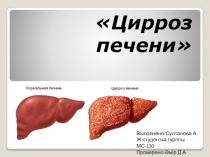 Цирроз печени