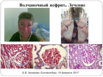 Волчаночный нефрит. Лечение
Е.В. Захарова. Екатеринбург, 18 февраля 2017