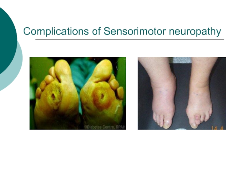 Complications of Sensorimotor neuropathy