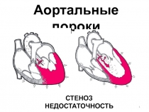 Аортальные пороки