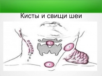 Кисты и свищи шеи