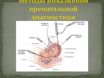 Методы инвазивной пренатальной диагностики