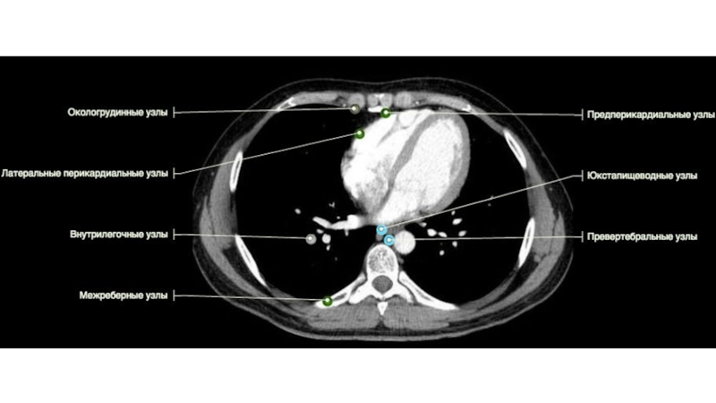 Кт органов грудной клетки. Парамедиастинально на кт. Кт органов грудной клетки с обозначениями. Гиперденсная СМА на кт.