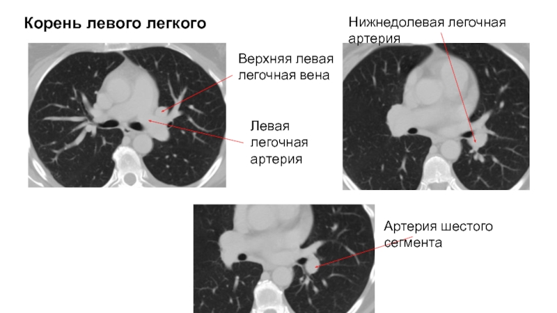 Левый корень. Легочная артерия и Вена кт. Нижнедолевая артерия легкого. Правая легочная артерия на кт.