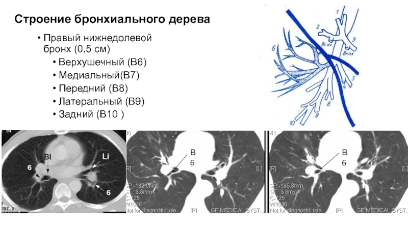 Бронхи схема кт