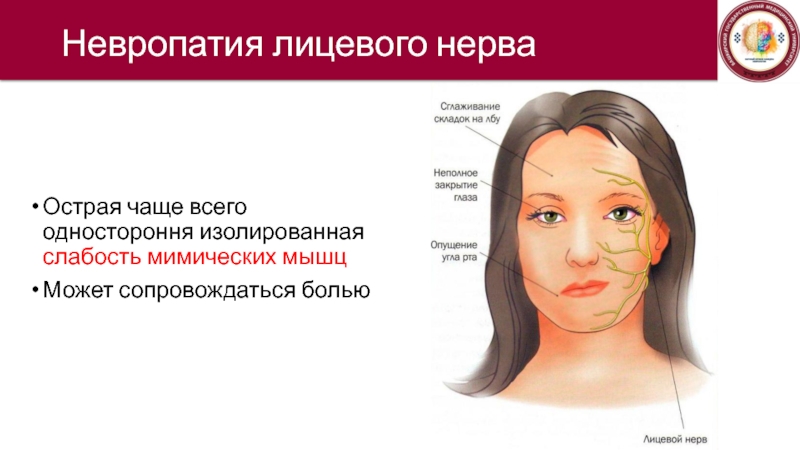 Невропатия лицевого нерва мкб. Лицевой нерв шкала. Сенсорно-вегетативная невропатия.