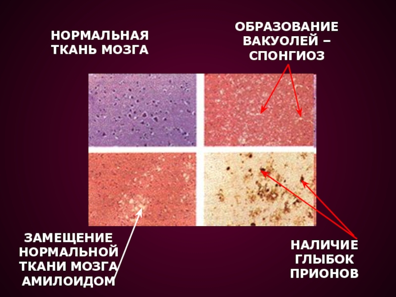 Нормальная ткань. Прионы история открытия. Прионные болезни гистология. Прионы ткани мозга.