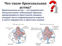 Что такое бронхиальная астма?