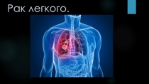 Рак легкого