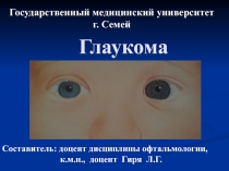 Глаукома
